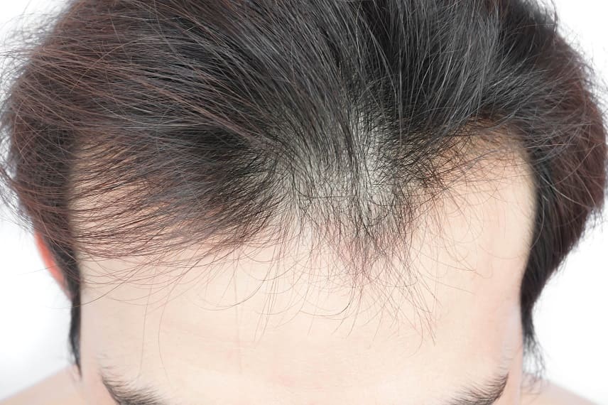 Haarausfall durch verstopfte Poren
