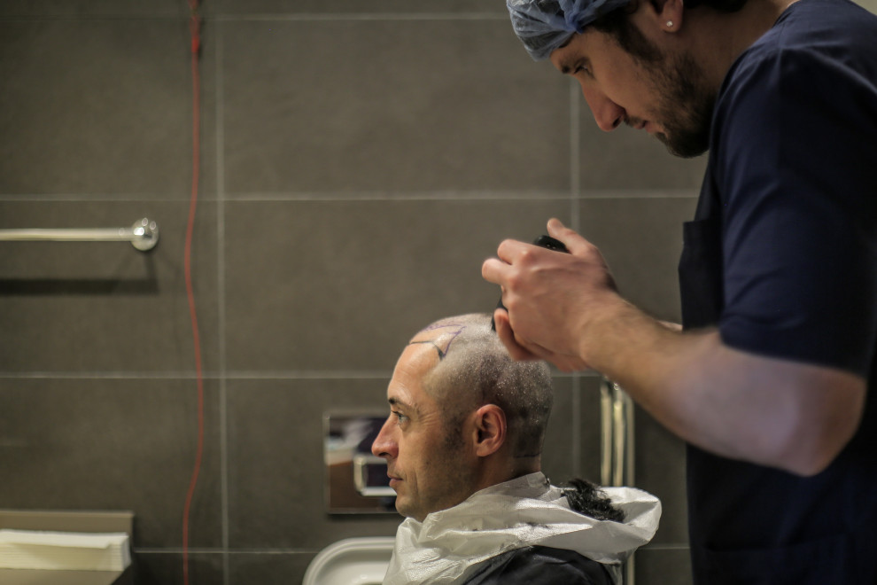 Mann bekommt vor der Haartransplantation den Kopf rasiert