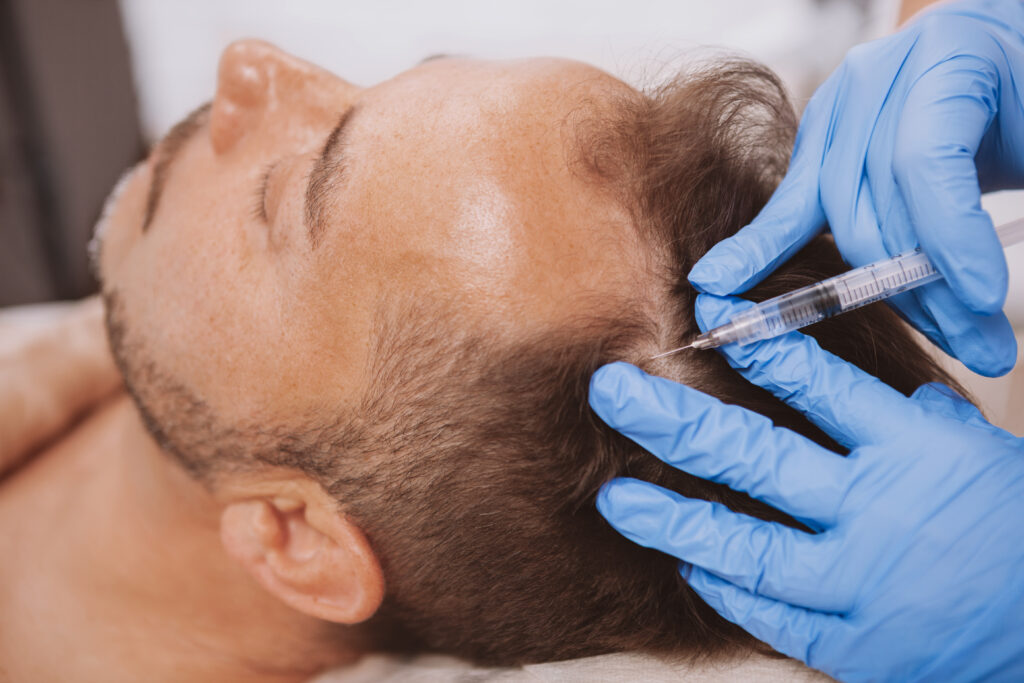Mann bekommt eine PRP Injektion gegen Plötzlicher Haarausfall