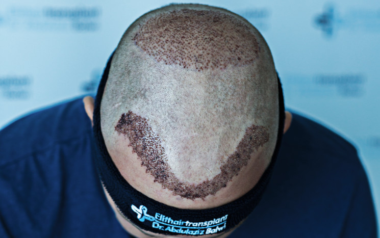 Nahaufnahme nach Haartransplantation Krusten entfernen - besser nicht gleich
