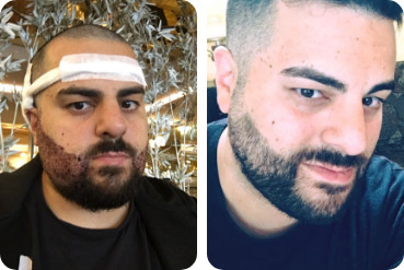 Young patient beard transplantation before after