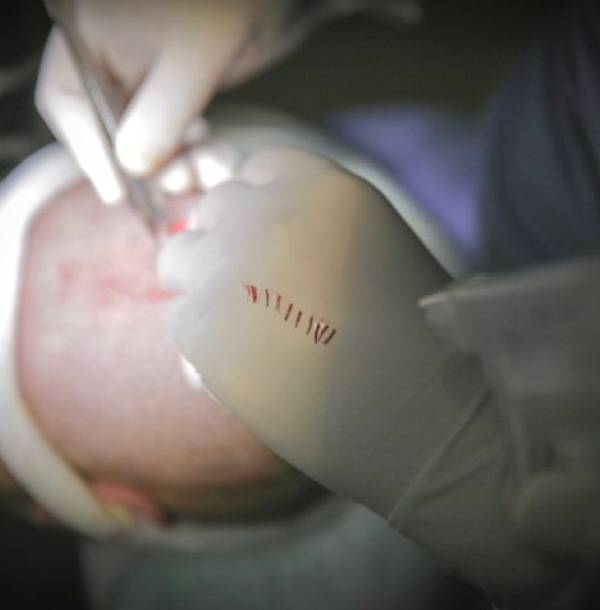 Grafts nach der Entnahme aus dem Spenderbereich
