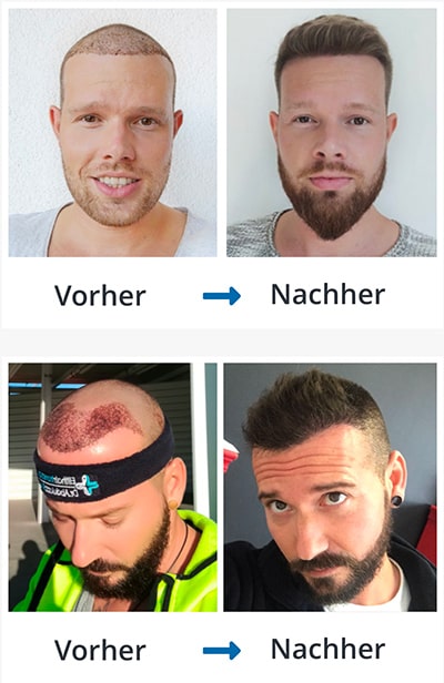 Männern haartransplantation bei deutschland in eine kostet was Haartransplantation bei