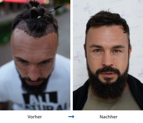 Vorher Nachher Ergebnis bei Geheimratecken