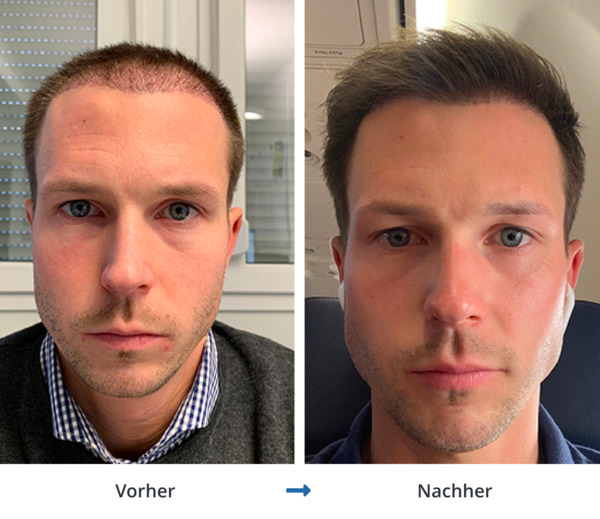 Vorher Nachher Bild einer erfolreichen Haarvepflanzung bei einer hohen Stirn