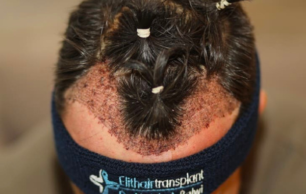 Haartransplantation ohne Rasur mit der SDHI-Technik
