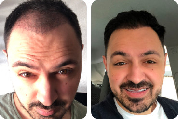 Male patient hair treatment for thick hair before and after comparison