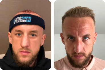 Male patient with high forehead own hair transplant before after