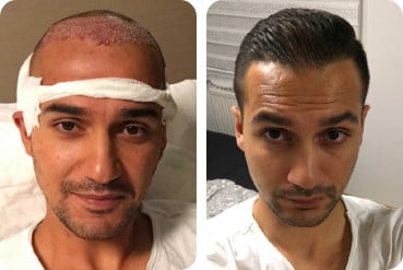 Hair transplantation of 3,000 grafts in male patients with high forehead before and after the procedure