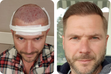 Hair transplant patient man high forehead before and after