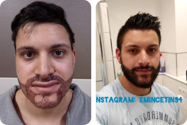 Young male patient beard hair transplant before after