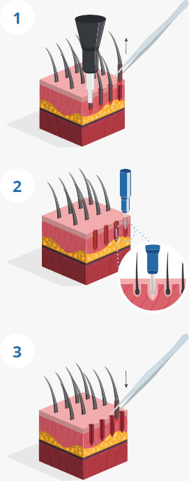 Grafik zum Ablauf der Entnahme der Grafts bei der FUE Haartransplantation