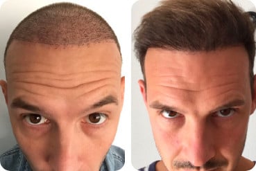 Patient for hair thickening by hair transplantation before and afterwards