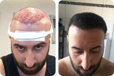 High forehead patient before and after hair transplantation with 3,500 grafts