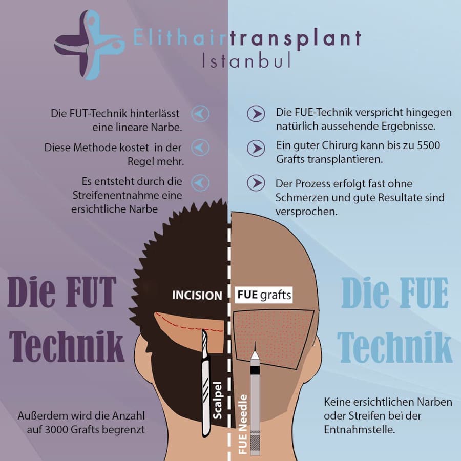 Haartransplantation Methoden FUE vs FUT