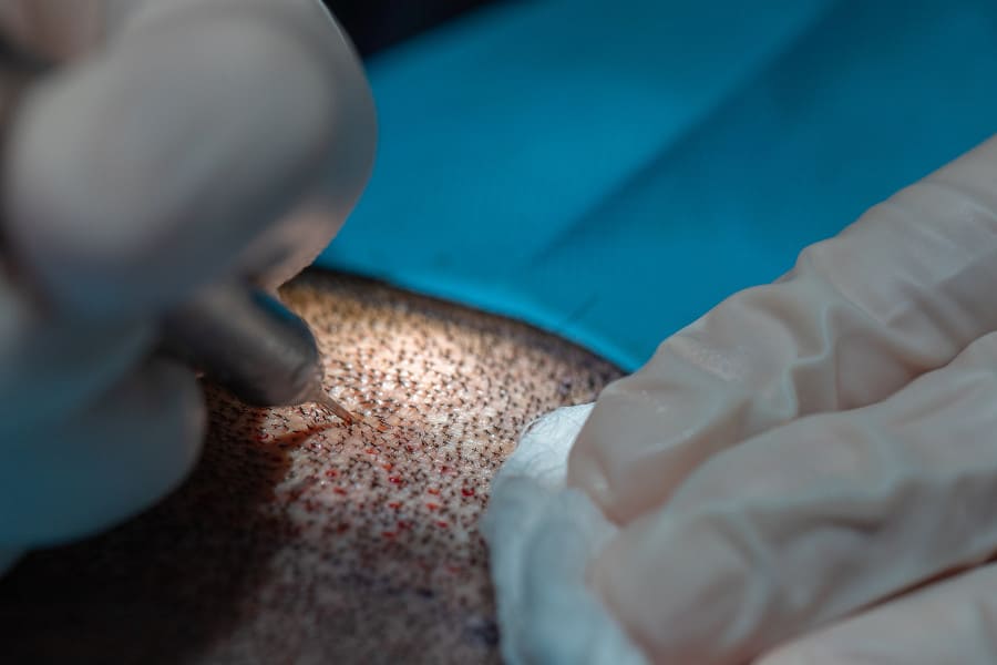 Nahaufnahme der Durchführung einer Haartransplantation.
