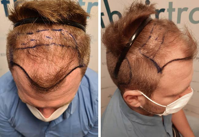 Vorher Saphir Haartransplantation mit 4500 Grafts bei Patient Kewin Lenzing