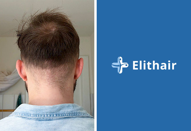 Haartransplantation Vorher Nachher Spenderbereich von Patient Eddie N.