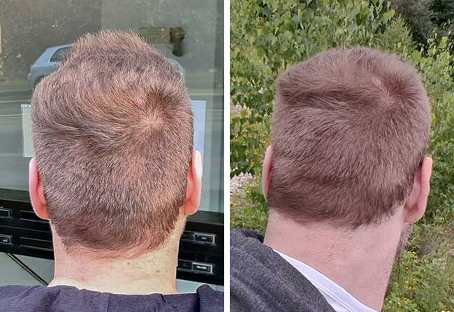 Haartransplantation Vorher Nachher Spenderbereich nach 8 Monaten von Patient Kewin