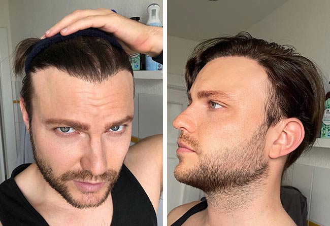 Nachher Saphir Haartransplantation mit 3700 Grafts bei Patient Eddie N.