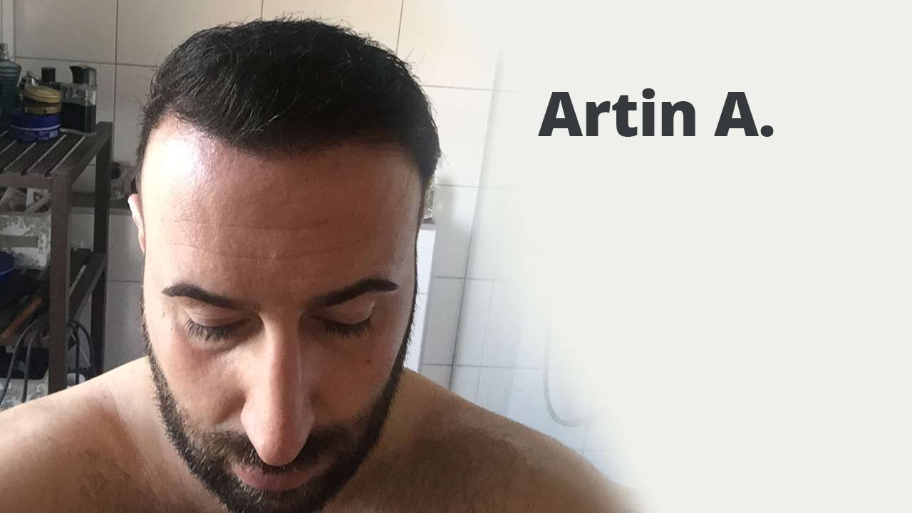 Thumbnail von Patient Artin Asrian bezüglich der Vorher Nachher Haartransplantation