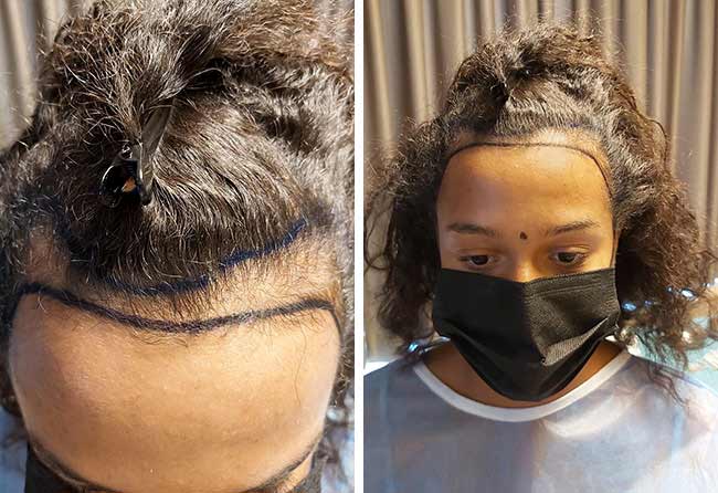 Vorher Saphir Haartransplantation mit 2700 Grafts bei Patientin Melissa Zerhau