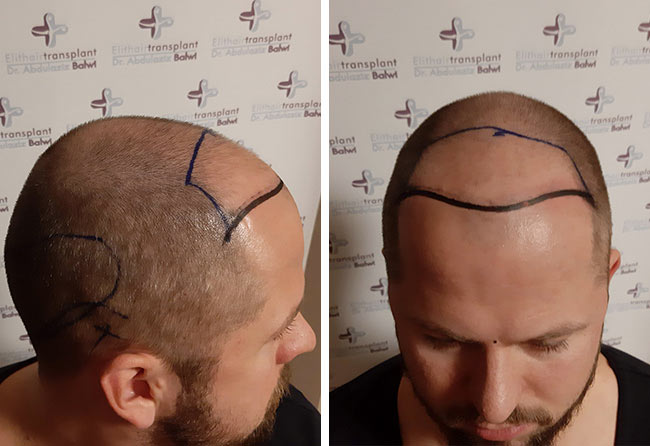 Vorher Saphir Haartransplantation mit 2800 Grafts bei Patient Nico Gumlich