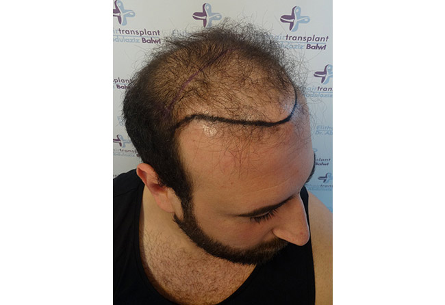 Vorher Saphir Haartransplantation mit 3500 Grafts bei Patient Artin Asrian