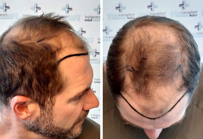 Vorher Saphir Haartransplantation mit 4100 Grafts bei Patient Marcus Medwed