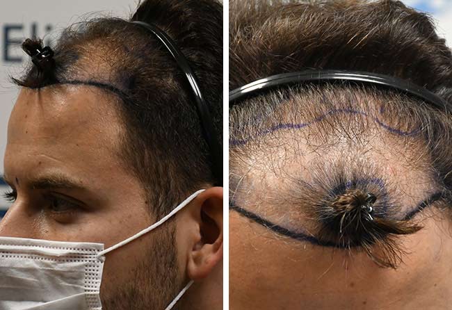 Vorher Saphir Haartransplantation mit 4200 Grafts bei Patient Marcel Oliva