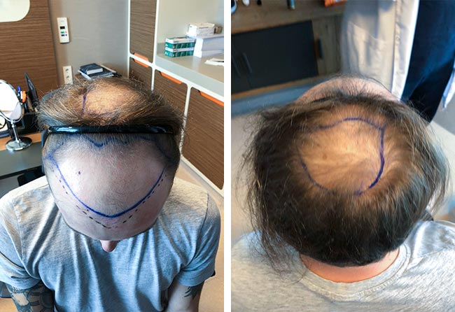 Vorher Saphir Haartransplantation mit 4700 Grafts bei Patient Frederik Gigers