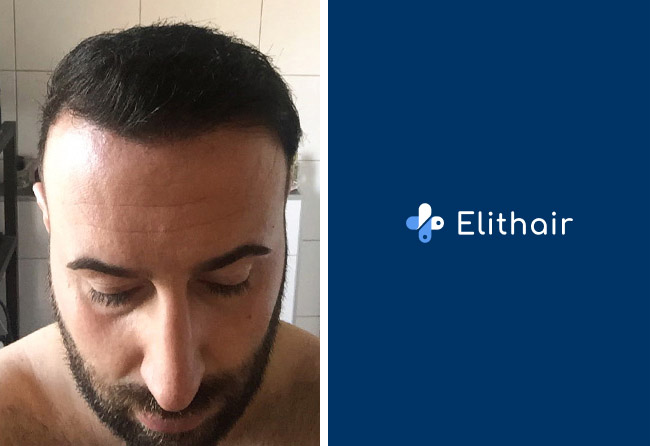 Nachher Saphir Haartransplantation mit 3500 Grafts bei Elithair Patient