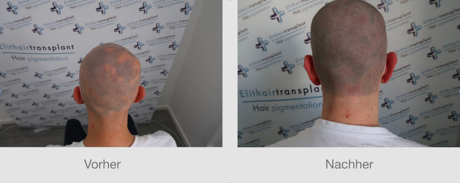 Kreisrunder Haarausfall bei einem Patienten auf dem Kopf Kreisrunder Haarausfall bei einem Patienten auf dem Kopf