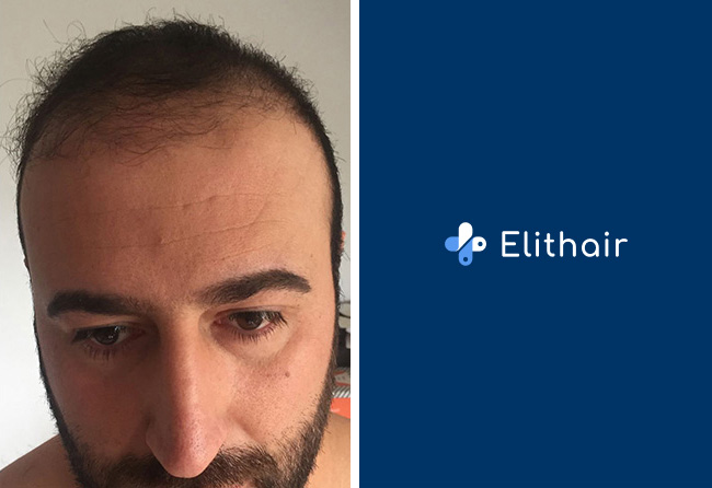 Vorher nachher Saphir Haartransplantation mit 3500 Grafts bei Elithair Patient nach 3 Monaten