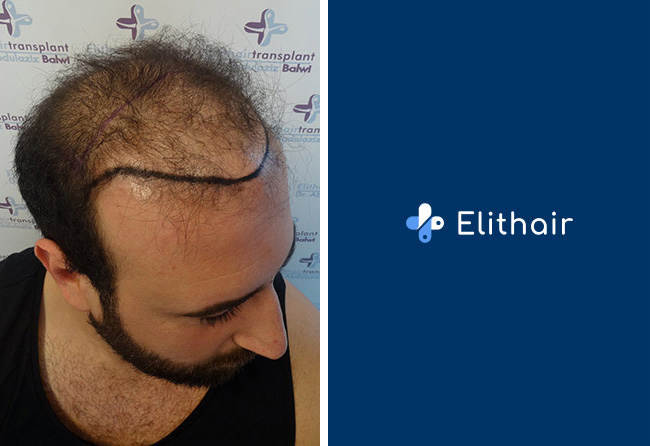Vorher Saphir Haartransplantation mit 3500 Grafts bei Elithair Patient