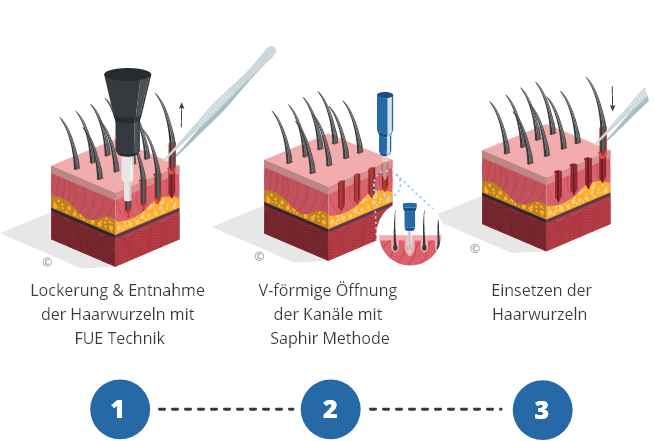 Infografik über die Saphir-Haartransplantation