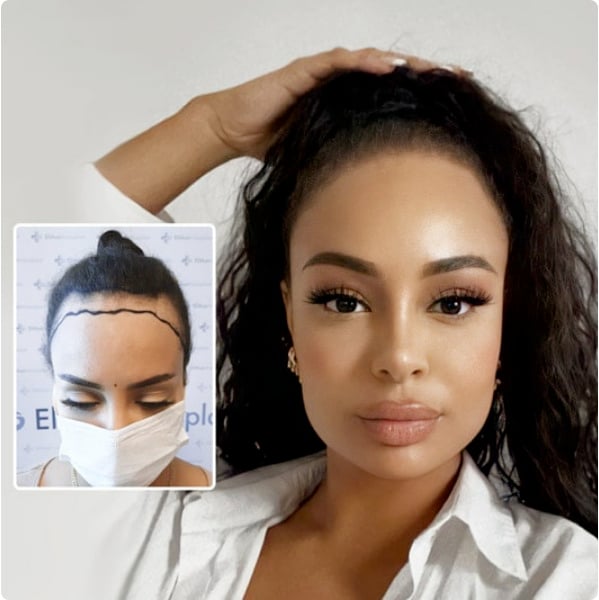 Kosten für haartransplantation