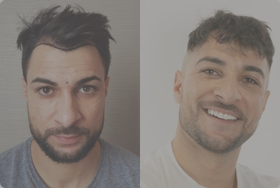 Osmani berichtet über seine Erfahrung bei seiner Haartransplantation