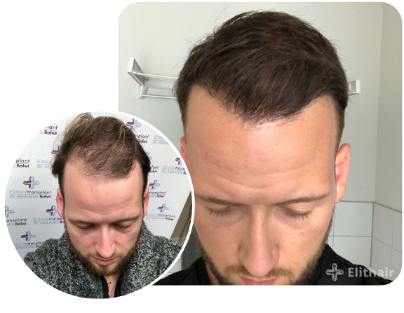 Patient nach Elithair DHI Haartransplantation mit 3000 Grafts