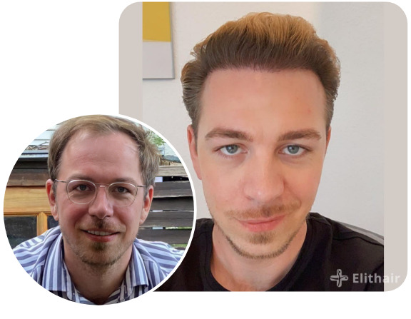 Patient nach Elithair DHI Haartransplantation mit 4850 Grafts