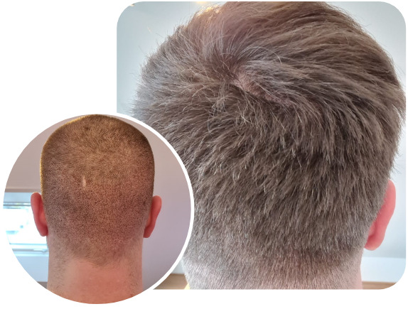Patient nach Elithair FUE Haartransplantationstechnik mit 3100 Grafts