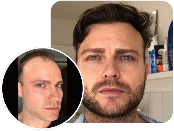 Patient nach Elithair FUE Haartransplantationstechnik mit 3700 Grafts