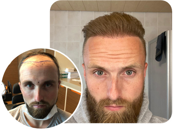 Patient nach Elithair FUE Haartransplantationstechnik mit 4700 Grafts