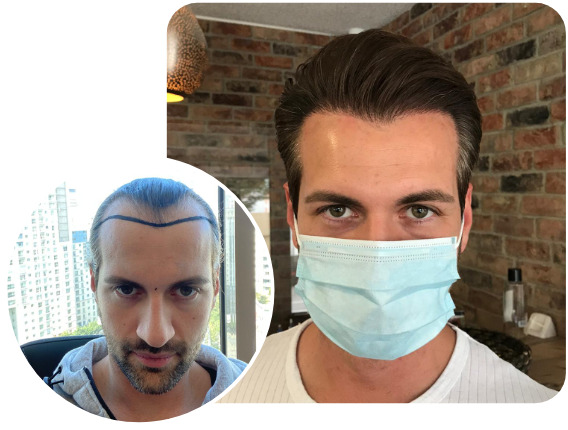 Patient nach Elithair Saphir Haartransplantationstechnik mit 3800 Grafts