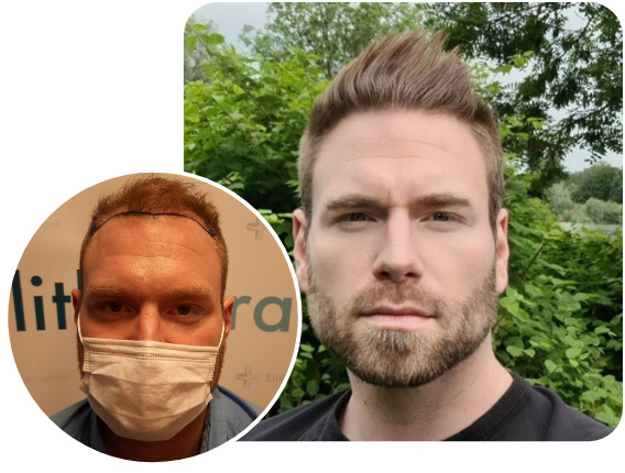 Patient nach Elithair Saphir Haartransplantationstechnik mit 4000 Grafts