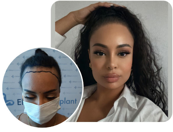 Patient nach Elithair SDHI Haartransplantation mit 3200 Grafts