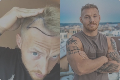 Steph berichtet über seine Erfahrung bei seiner Haartransplantation