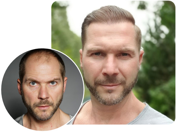Vorher und nachher Vergleich bei einem NEO FUE Patienten mit 4200 Grafts