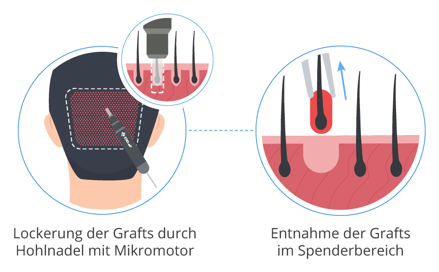 Grafik zur Lockerung und Entnahme der Grafts im Empfängerbereich