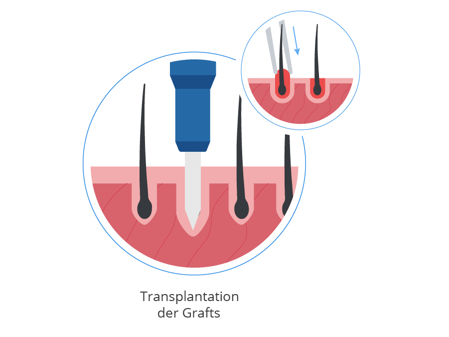 Grafik zur Verpflanzung bei der Saphir Haartransplantation
